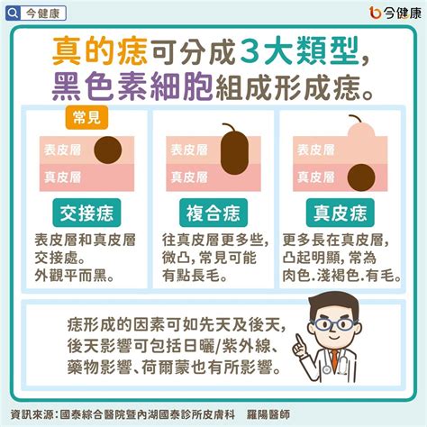 痣上面長痘痘|是痣or皮膚癌？醫「1張圖秒對照」 長這2部位最危險